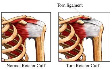 Bench Press Shoulder Pain Rotator Cuff
