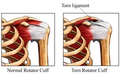 Injured Rotator Cuff Bench Press