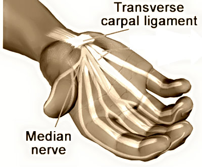 carpal tunnel syndrome tendons