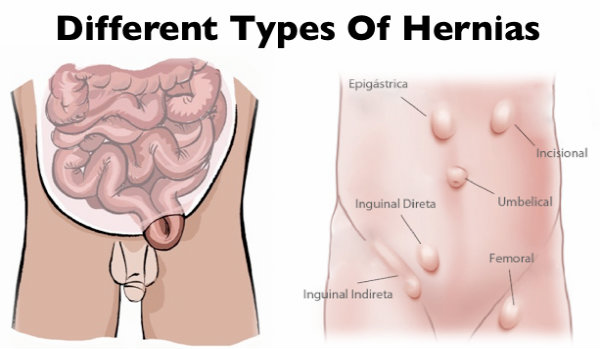 different-hernias